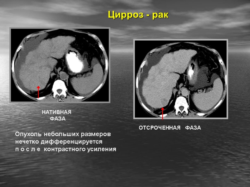 Цирроз - рак Опухоль небольших размеров нечетко дифференцируется п о с л е 